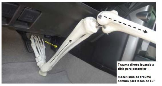 lesao-ligamento-cruzado-posterior-dr-diego-munhoz-ortopedista-cirurgia-joelho-sp