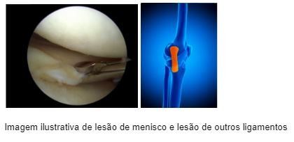 lesao-menisco-ligamento-cruzado-posterior-dr-diego-munhoz-ortopedista-cirurgia-joelho-sp