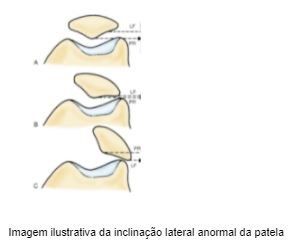 patela-lateralizada-joelho-dr-diego-munhoz-ortopedista-especialista-cirurgia-joelho-sao-paulo