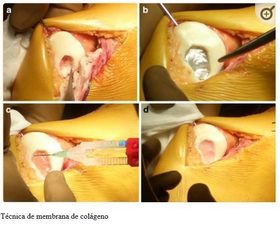 tratamento-joelho-dr-diego-munhoz-ortopedista-joelho-sp