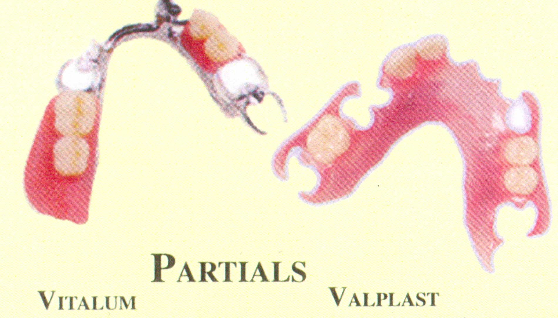 Partial Dentures
