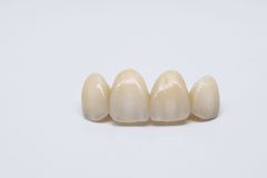 Dental Bridge