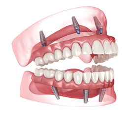 Implant Supported dentures
