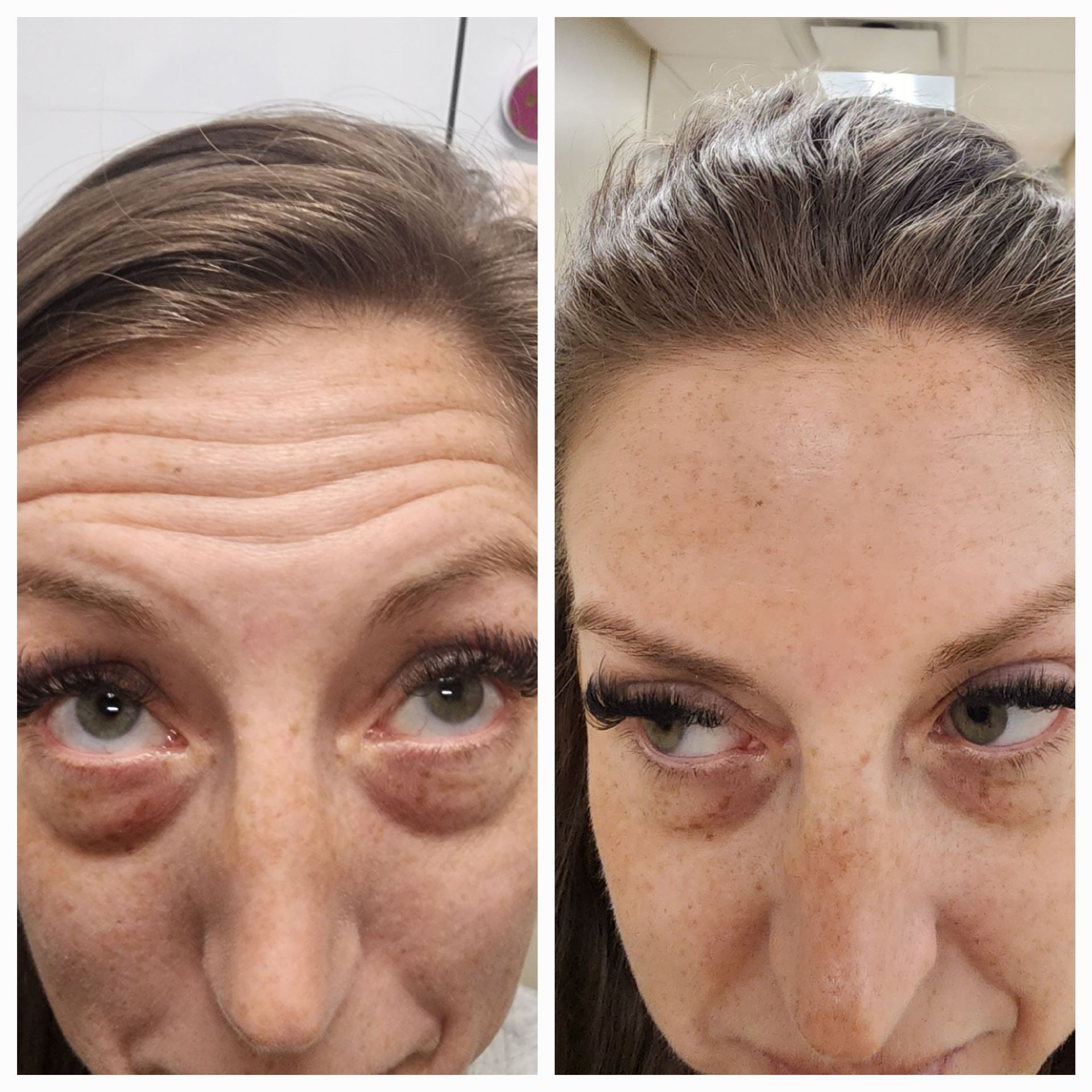 A before and after photo of a woman 's forehead.