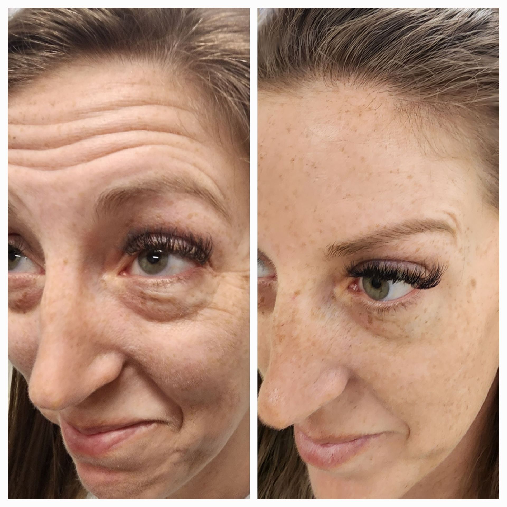 A before and after photo of a woman 's forehead.