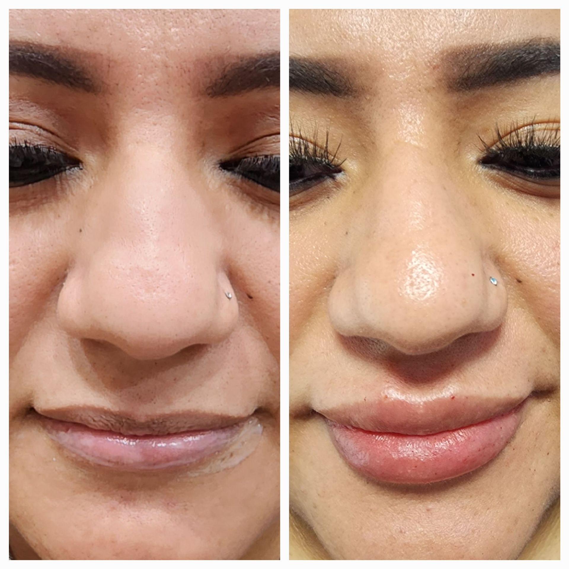 A before and after photo of a woman 's nose and lips.