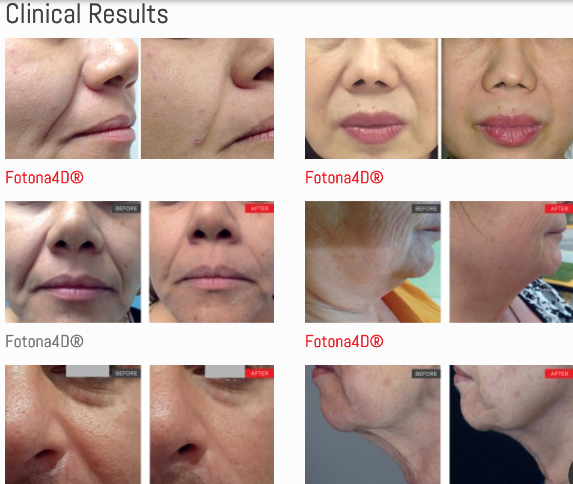 A collage of pictures of a woman 's face with the words clinical results at the top