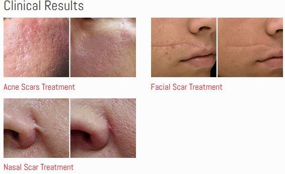 A picture of a person 's face with acne scars and facial scar treatment