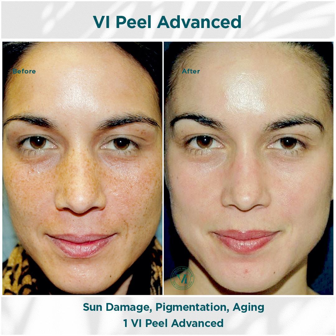 A before and after photo of a woman 's face with the caption vi peel advanced
