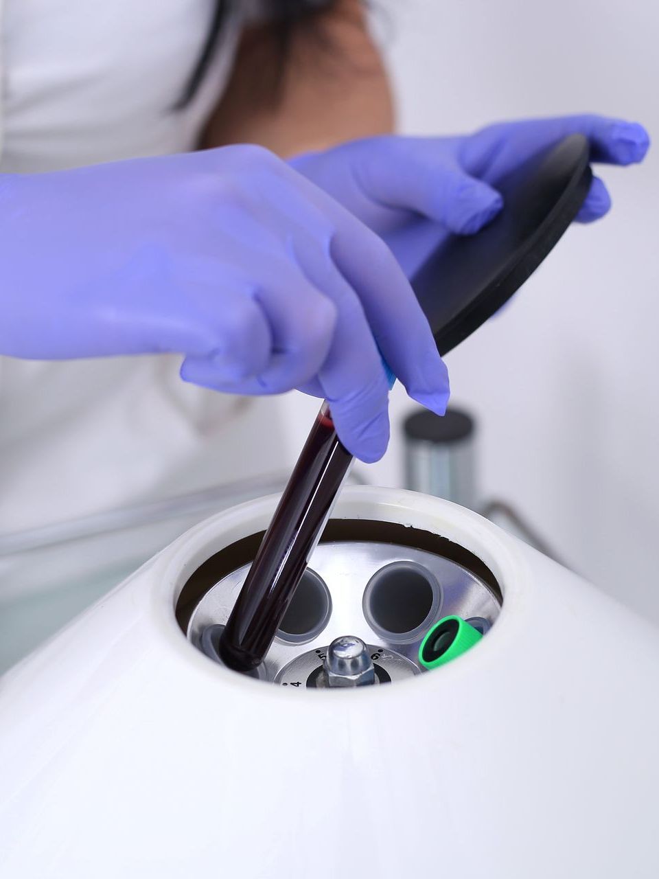 prp therapy in progress