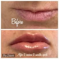 Before and after comparison showing lip enhancement results after two treatment sessions spaced two months apart.