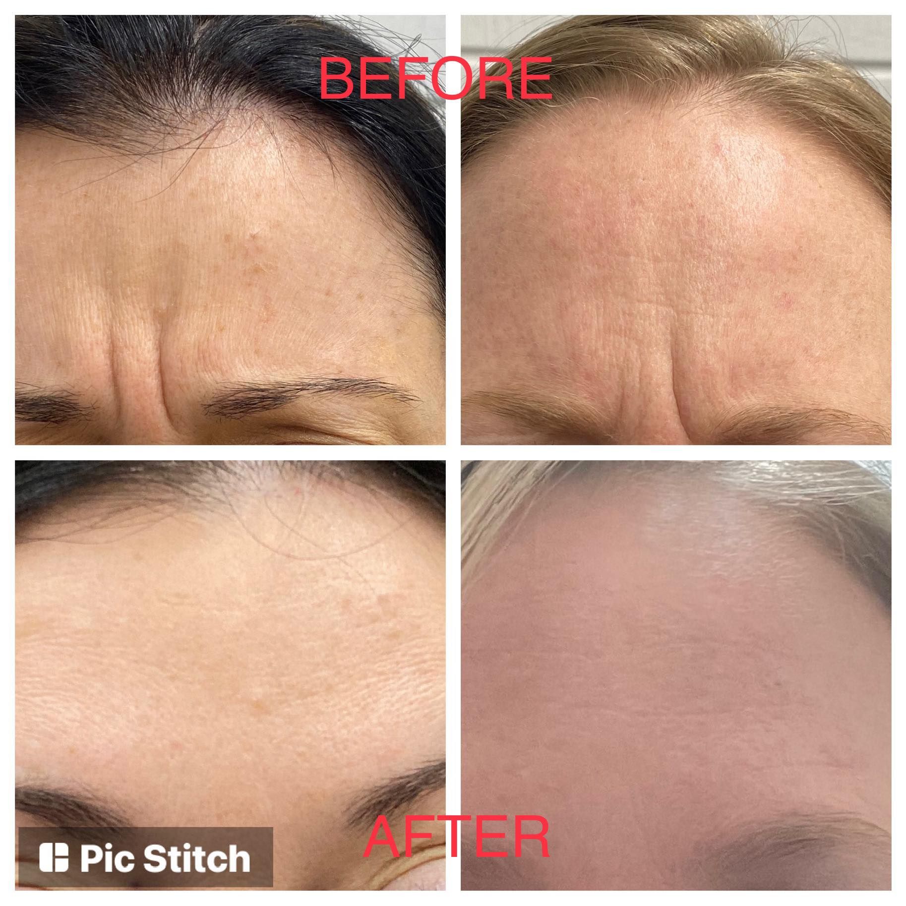Before and after comparison of a forehead showing a reduction in deep frown lines after treatment.