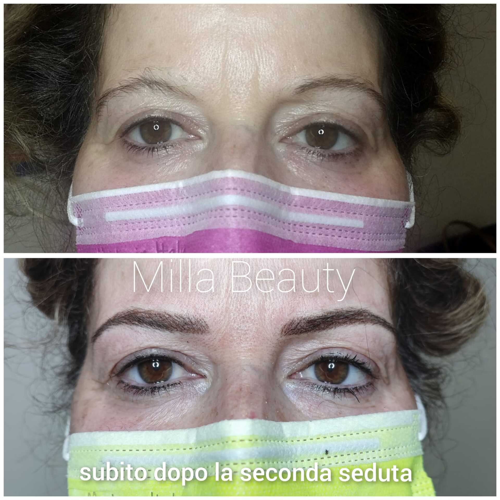 Confronto delle sopracciglia prima e dopo un intervento di chirurgia estetica, con una donna che indossa una mascherina.