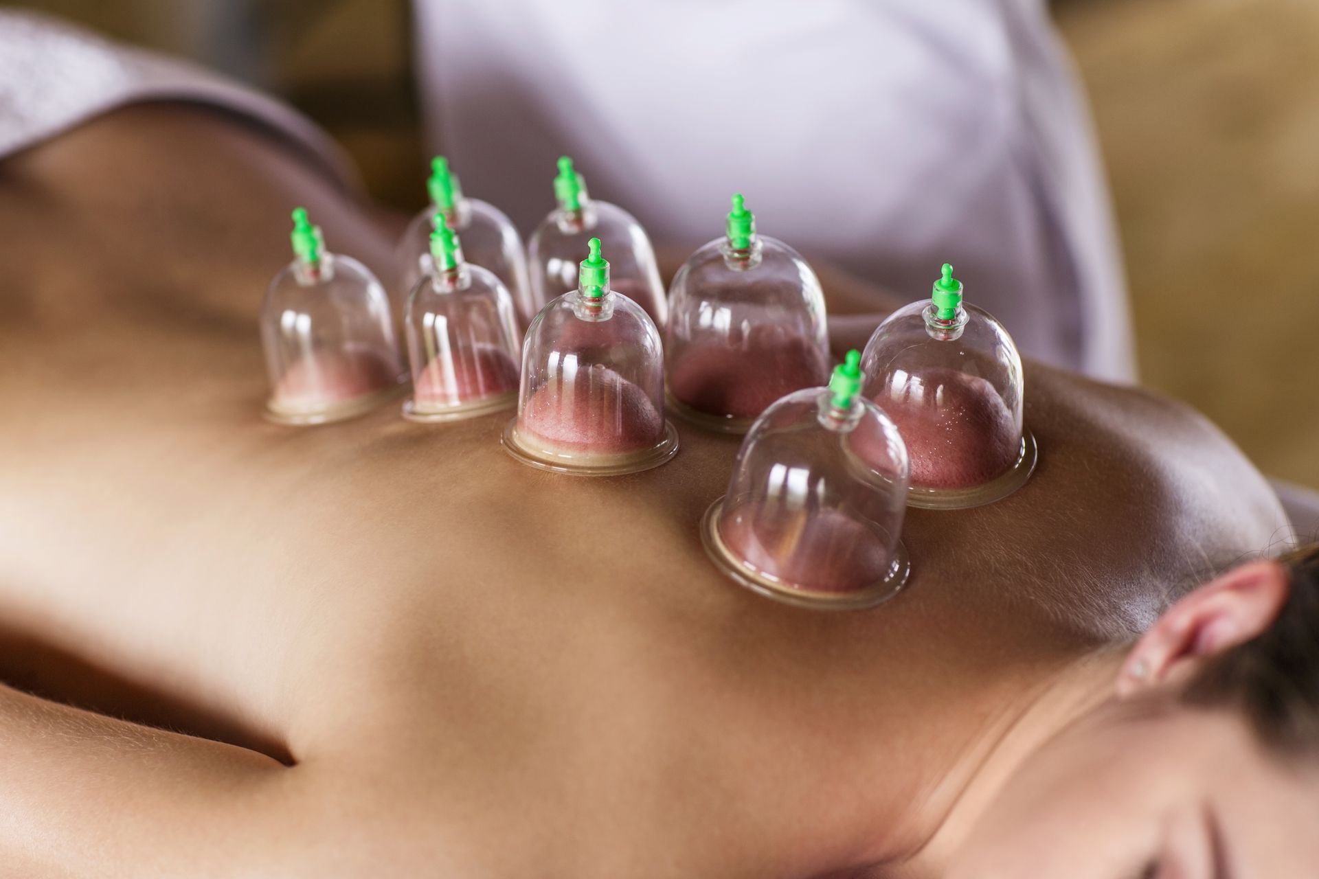 Cupping Massage Therapy Leaving Marks on Back — Massage Therapy in Kirwan, QLD