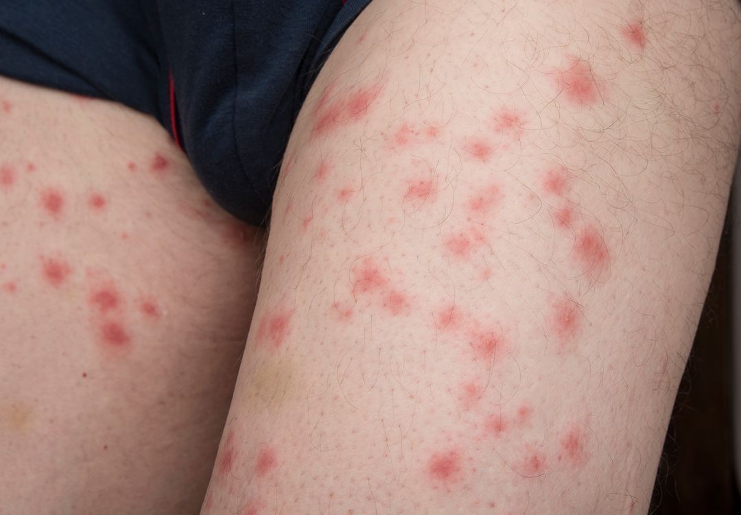 Jambe présentant de nombreuses lésions cutanées rouges, enflées et surélevées, probablement des piqûres d'insectes.