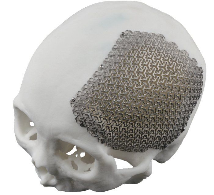Titanium Cranial PLates