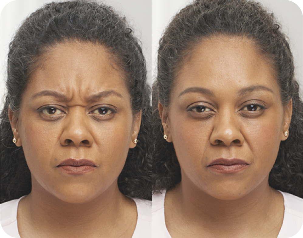 A before and after photo of a woman 's face with wrinkles.