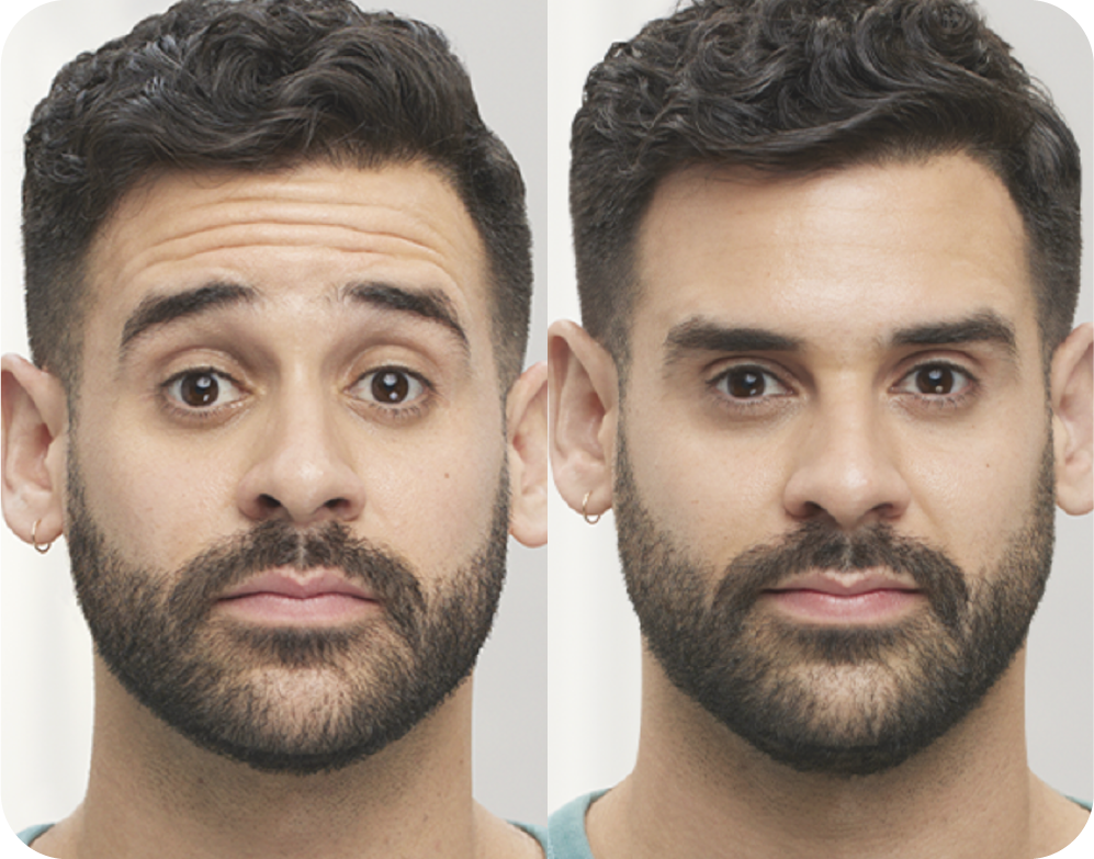 A before and after photo of a man after Botox.