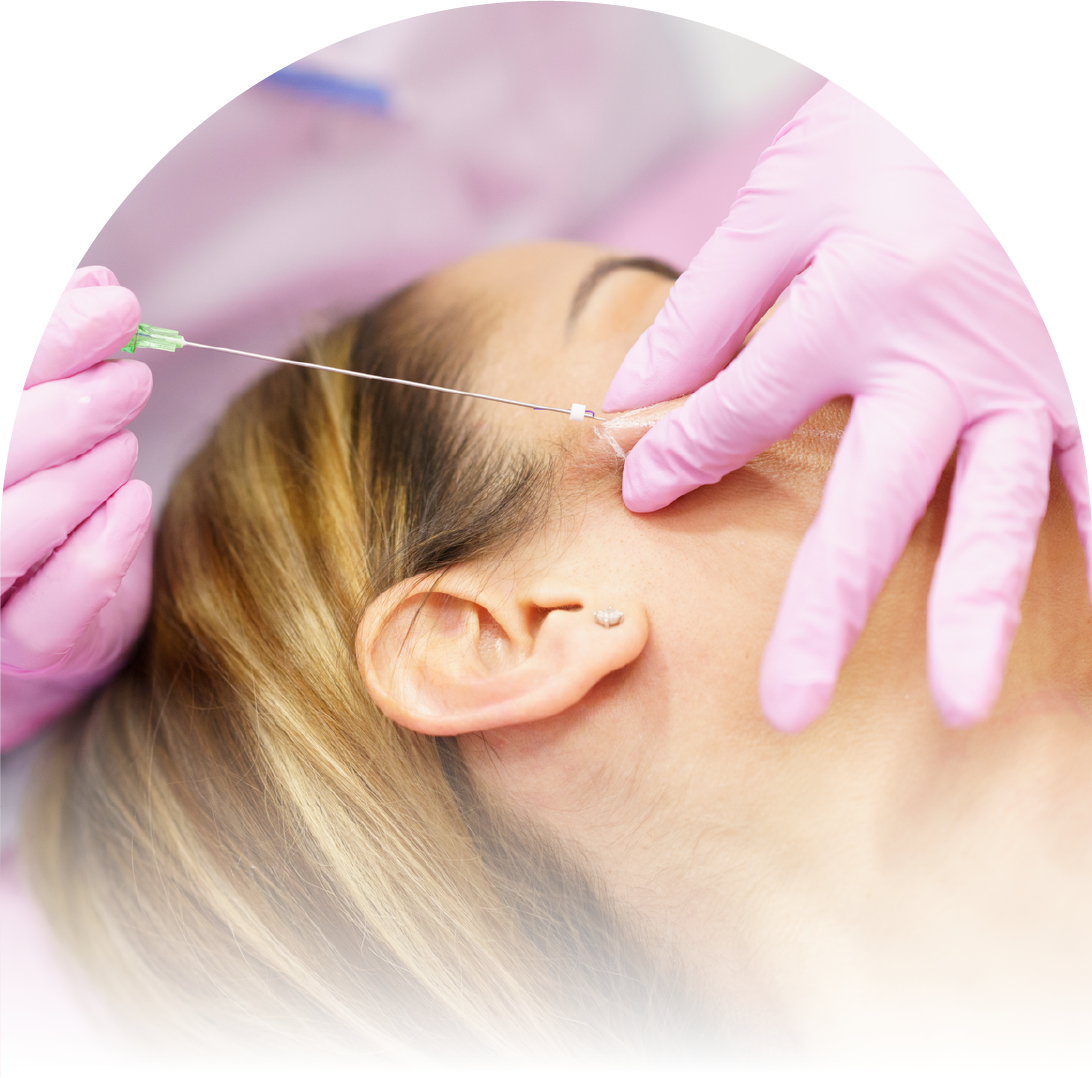 A woman is having a PDO Thread Treatment done.