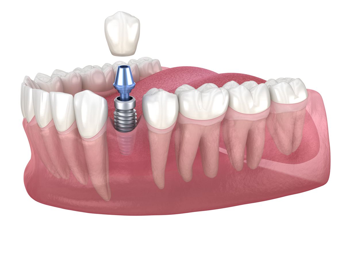 Diagram of a dental implant: a screw in the jaw, with a tooth crown above.