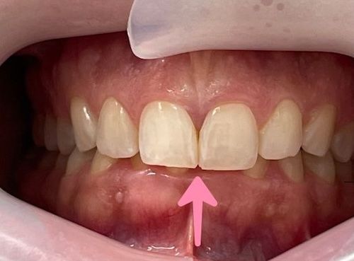 Close-up of mouth showing teeth. A pink arrow points to a gap between the two front teeth.