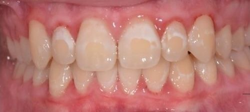 Close-up of human teeth with white spots, likely indicating enamel damage.