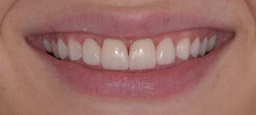 Close-up of a person's smiling mouth, revealing straight, white teeth. Pink lips and a slight parting between the front teeth.