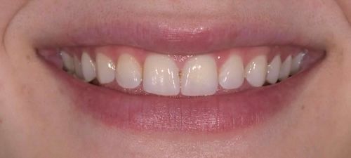 Smiling mouth showing white teeth and pink lips.
