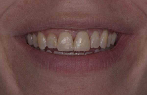 Close-up of a person's smiling mouth showing several white teeth.