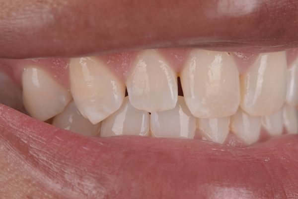 Close-up of teeth; some are slightly misaligned, with small spaces between them.