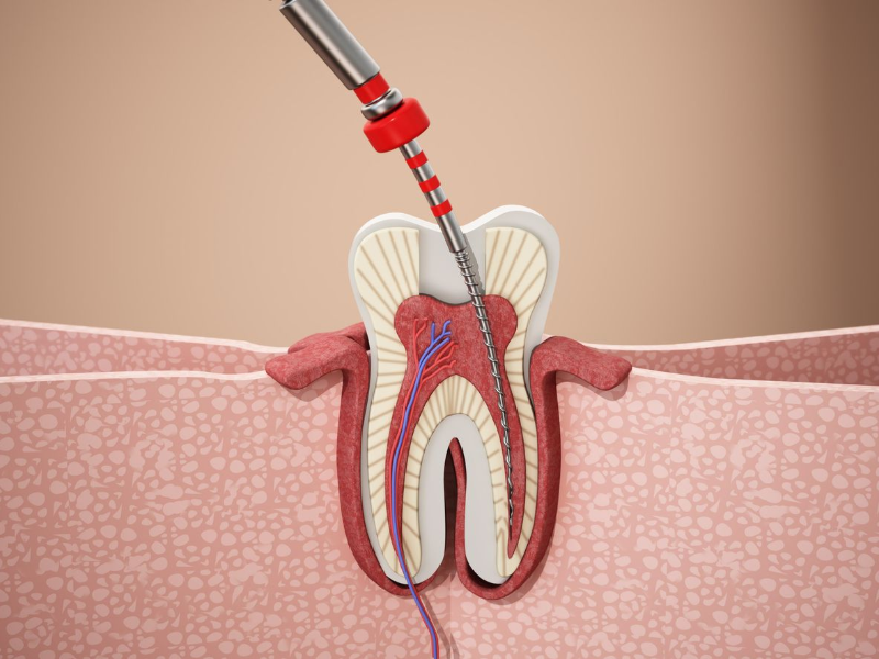 Root Canal Photo