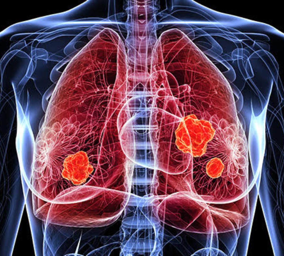 Systemic sclerosis scleroderma 
