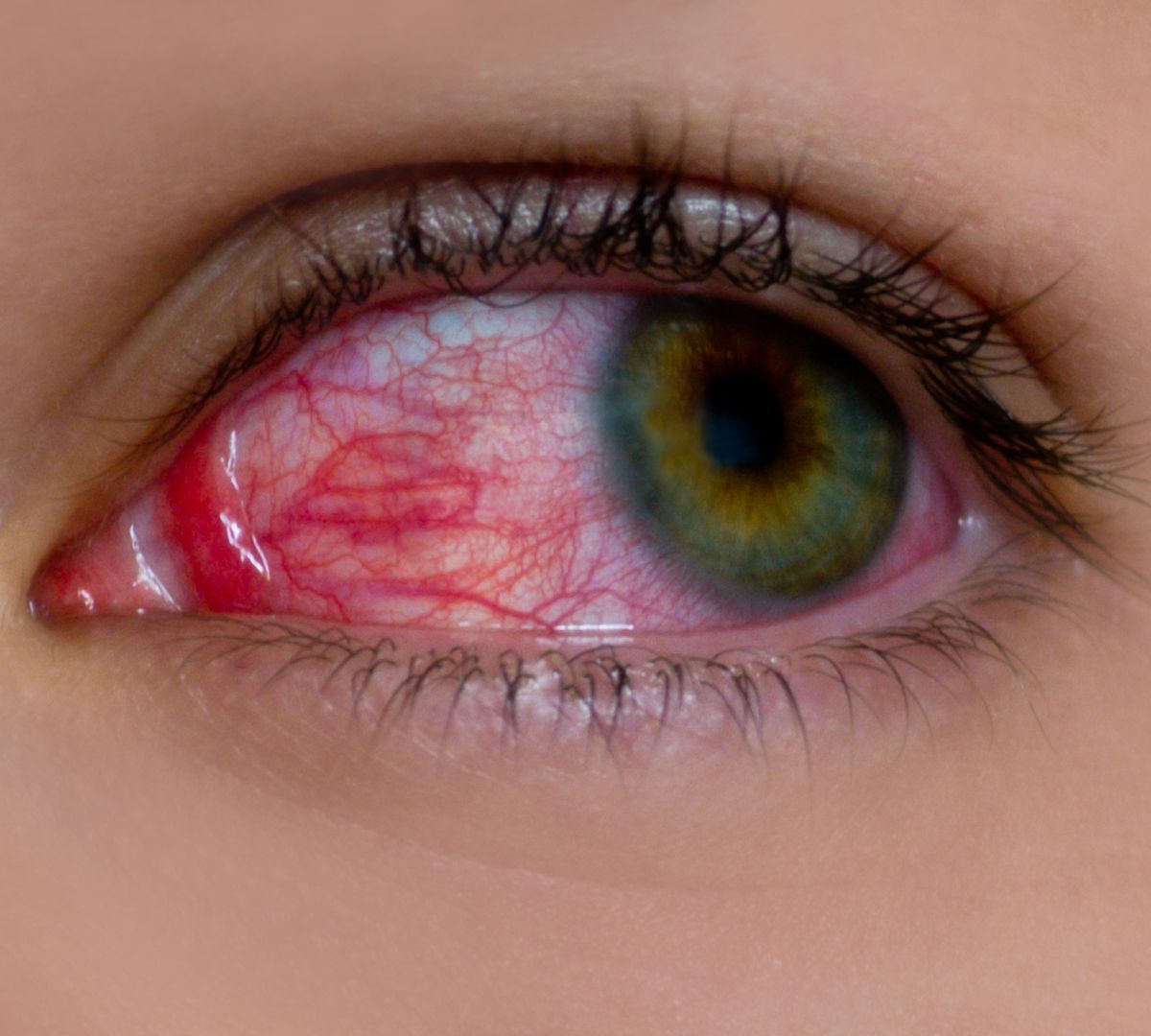 Relapsing Polychondritis