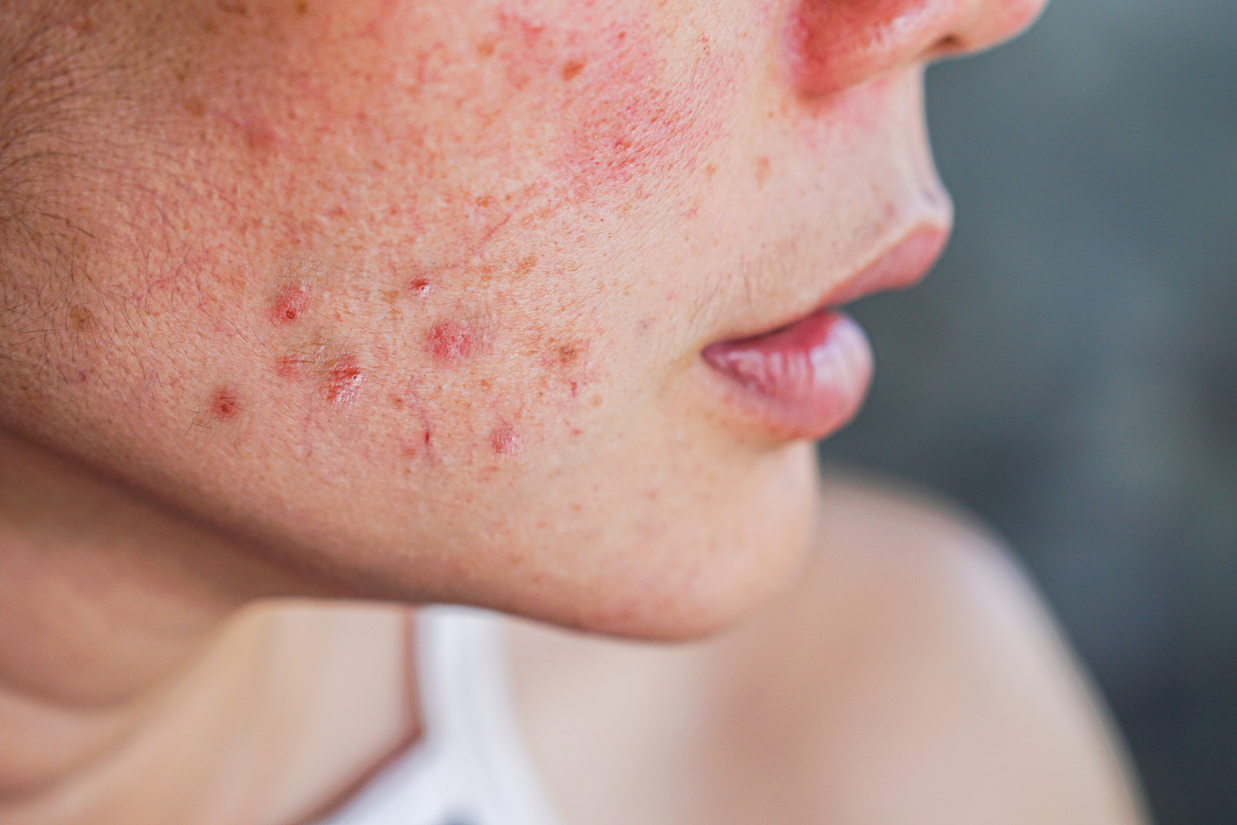 Skin rash and small bumps on the face, a typical skin problem seen in Behçet's Disease
