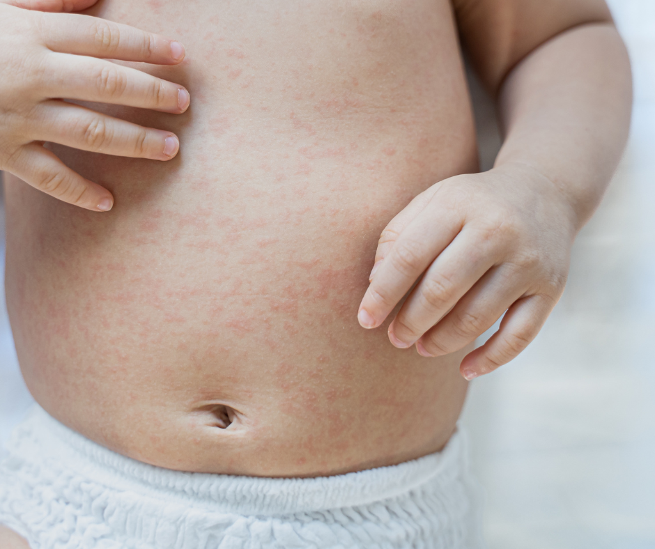 Close-up of baby's belly with red rash, small hands touching the irritated skin.