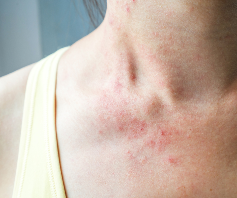 View of woman's neck and shoulder with a yellow tank top. She has a rash on her chest and neck.