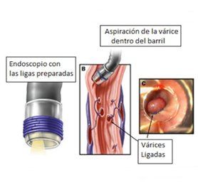 tratamiento de varices esófago gástricas