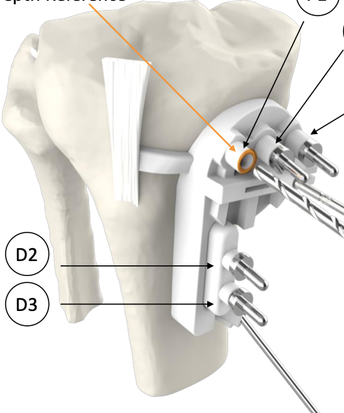 Dr Leie | Orthopaedic Surgeon Perth | Knee Osteotomy