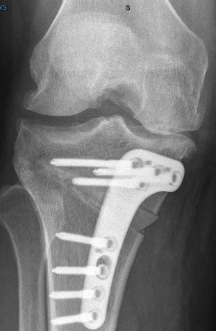 Dr Leie | Orthopaedic Surgeon Perth | Knee Osteotomy