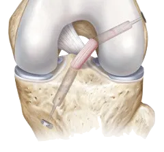 Kidney stone, urinary stone, ureteric stone, renal calculi, renal colic, nephrolithiasis