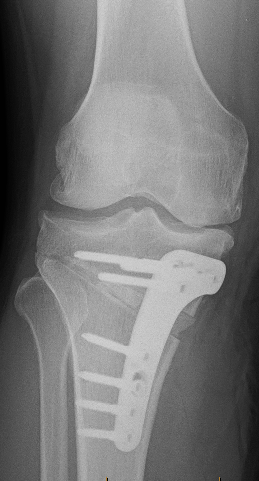 Dr Leie | Orthopaedic Surgeon Perth | Knee Osteotomy