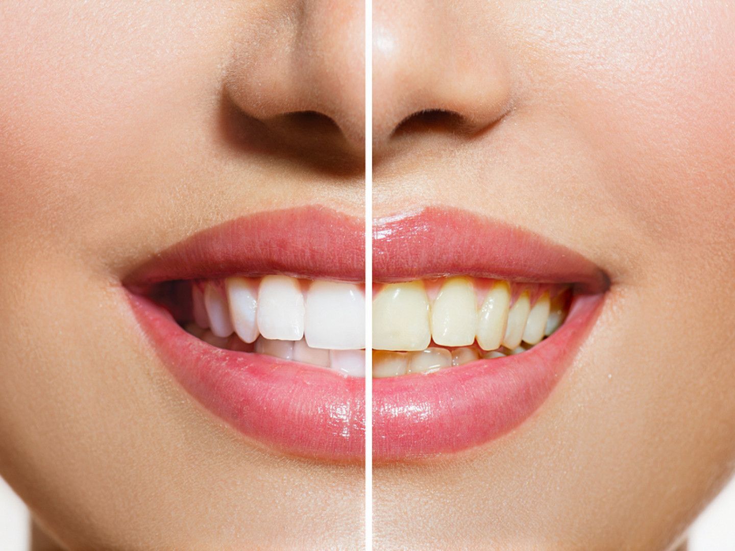 Side-by-side comparison of woman's smile; left: bright white teeth, right: stained yellow teeth.