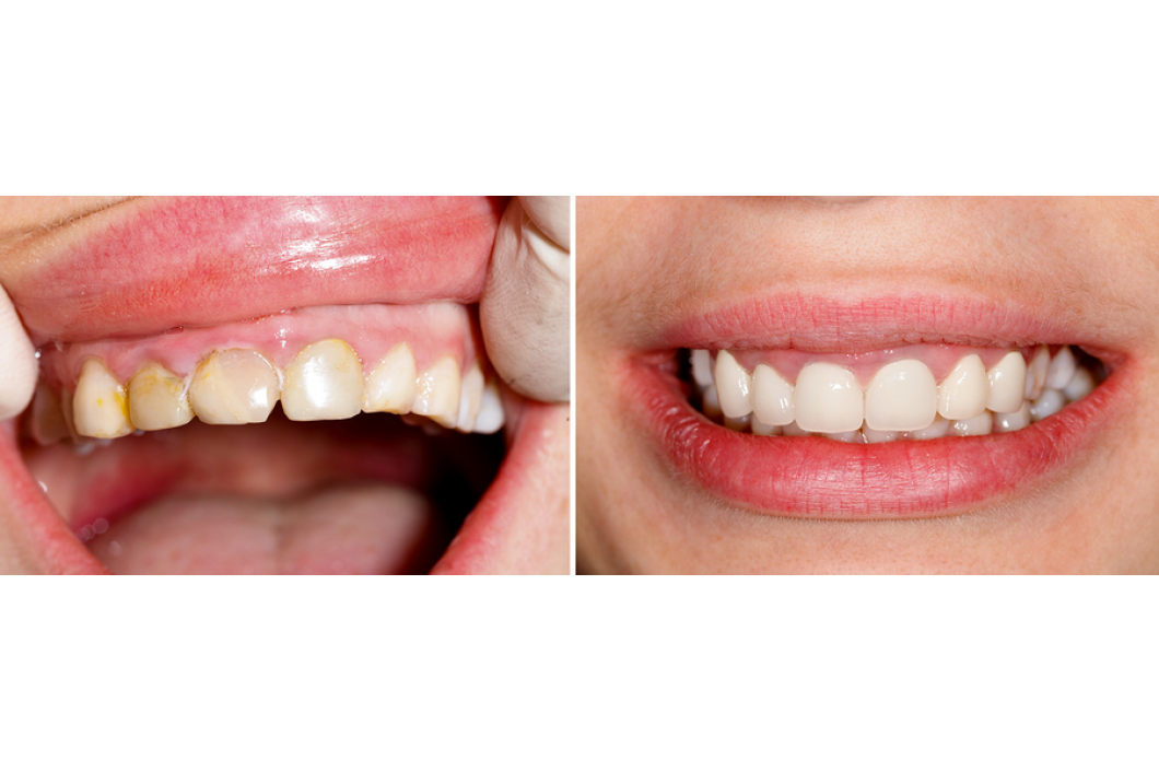 Before and after comparison of teeth. Left: yellow teeth. Right: Bright white smile.