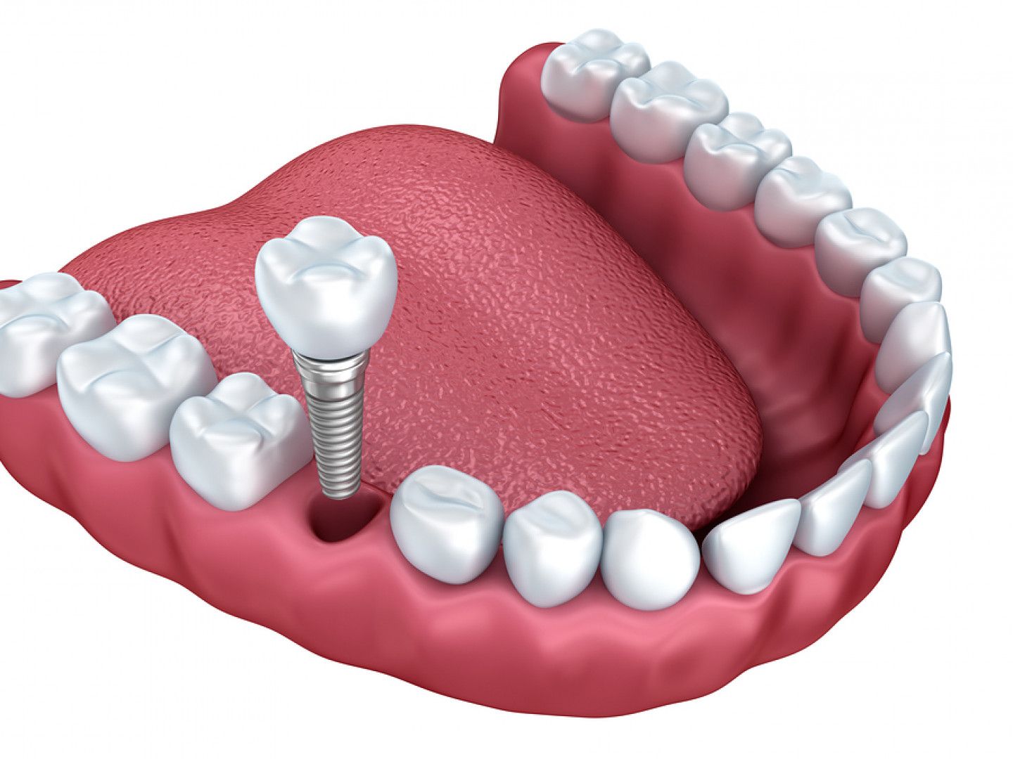 Dental illustration showing a tooth implant with surrounding teeth, tongue, and gums in red.