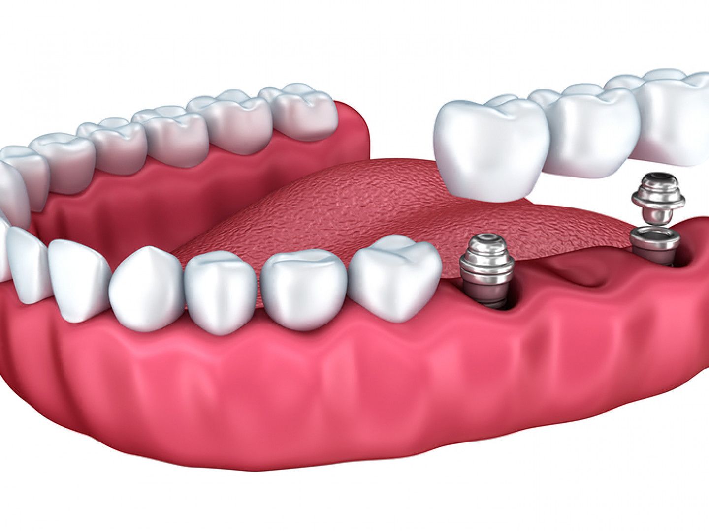 Diagram of a jaw with dental implants and a bridge, showing a row of white teeth and pink gums.