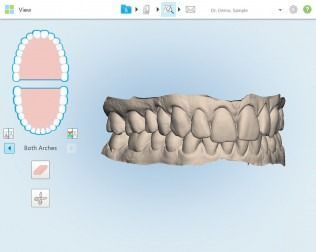3D dental scan of teeth, showing both arches. Gray model of the teeth on a blue background. Side and top views are shown.