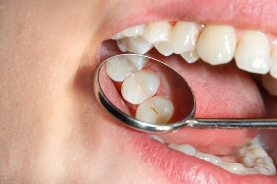 Dentist inspecting a tooth with a dental mirror inside an open mouth