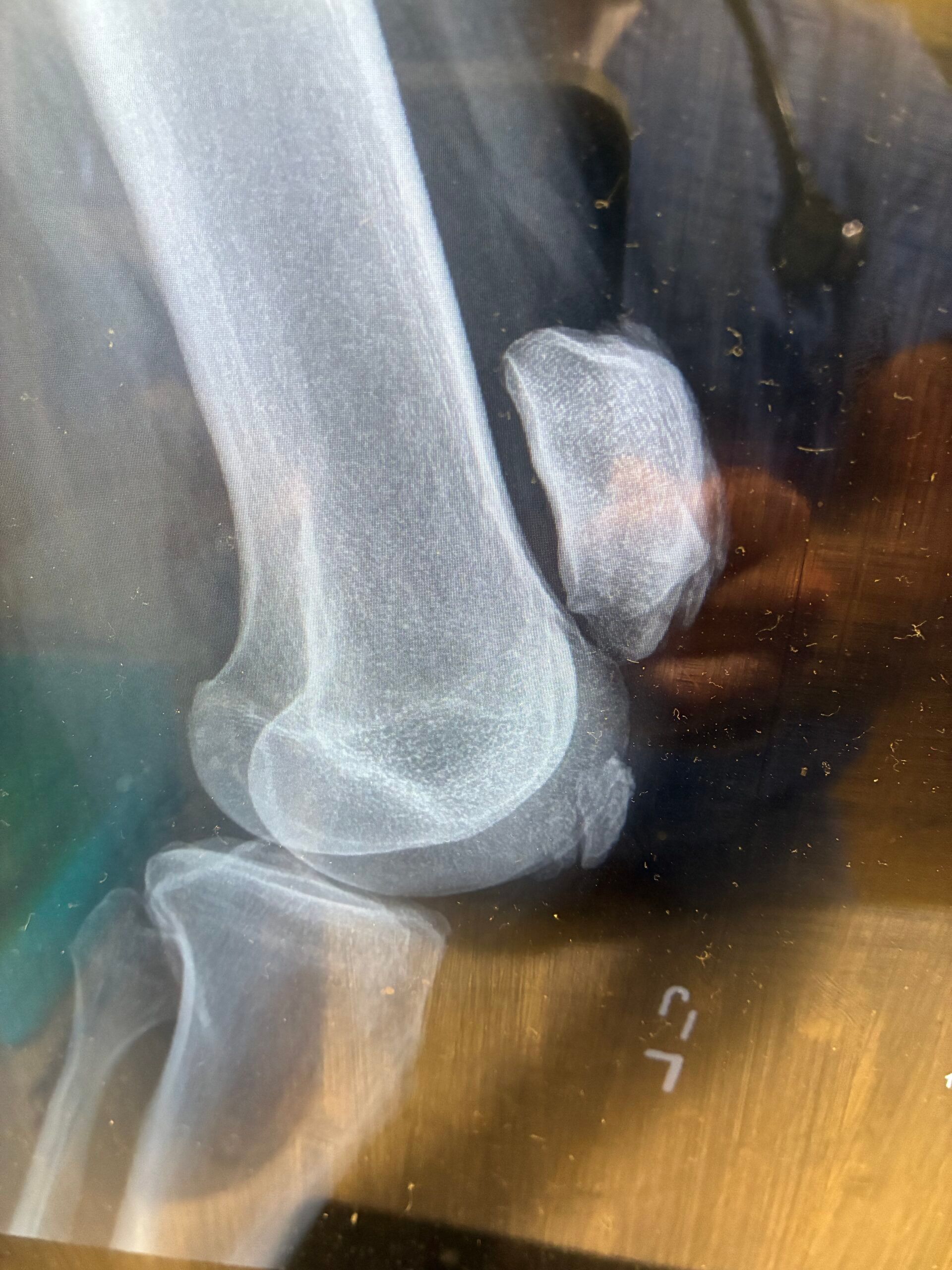 X-ray of a human knee joint, showing bones of the femur, tibia, and patella.