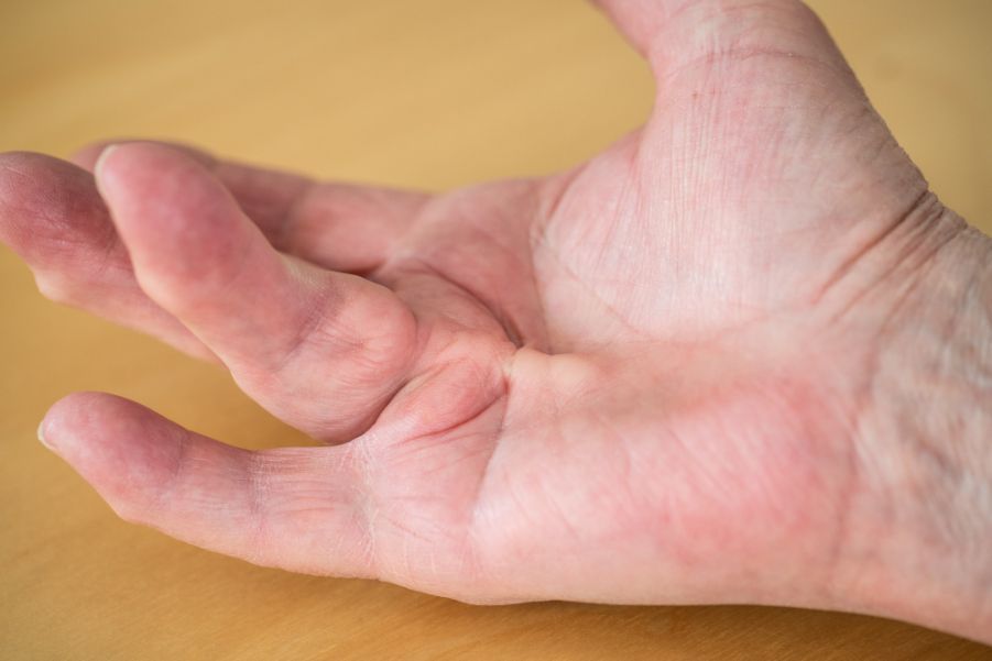 Dupuytren's Contracture