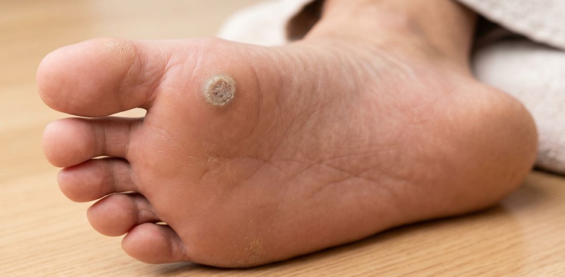 Plantar Warts A Guide to removal